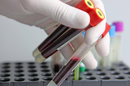 Xərçəng epidemiyasının əsas səbəbi açıqlandı