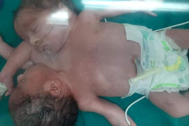В Египте родились близнецы с одним туловищем и четырьмя руками на двоих - ФОТО
