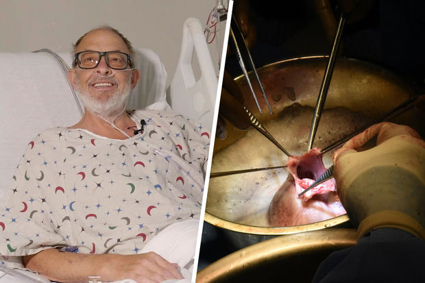 Хирурги успешно провели вторую в истории пересадку свиного сердца человеку