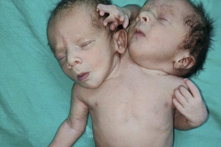 В Индии родился ребенок с двумя головами - ФОТО