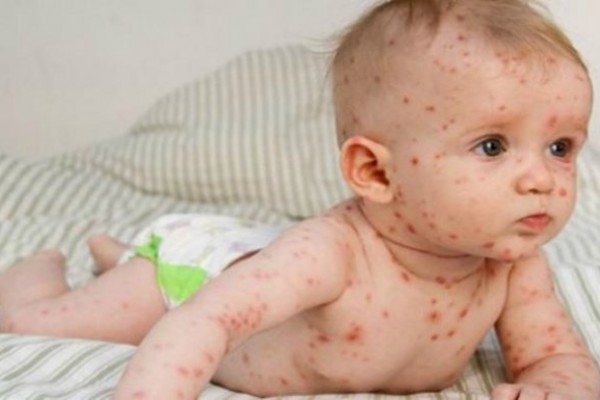“Vaksinə görə qızılcanı süni şəkildə yayırlar”-iddiasına pediatrdan SƏRT REAKSİYA
