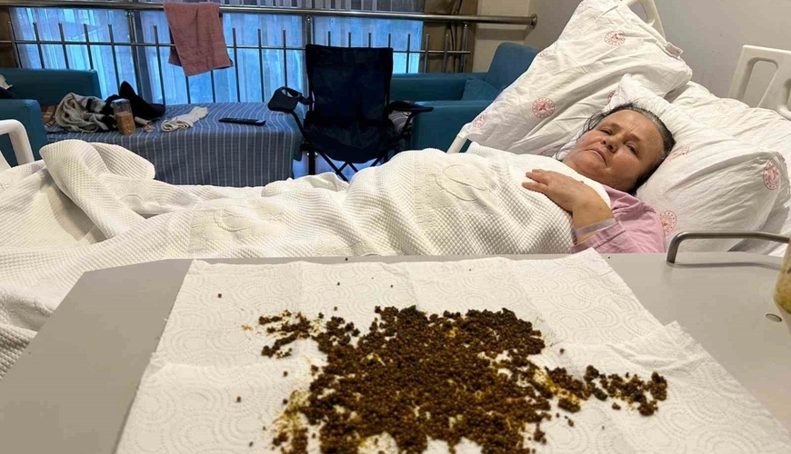 Рекордное количество желчных камней удалено у 70-летней пациентки в Турции - ФОТО