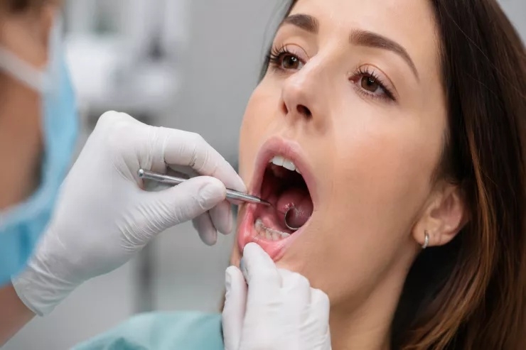 Ağız xərçəngi çox vaxt nəzərə çarpmayan bir əlamətlə başlayı